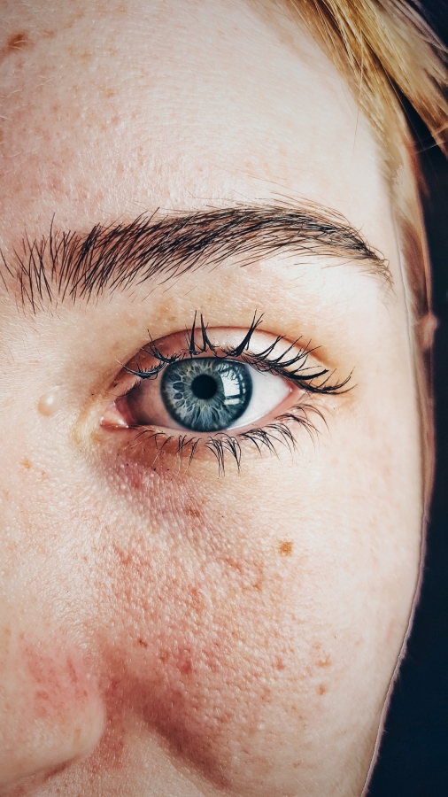 Having a skin condition is nothing to be ashamed about